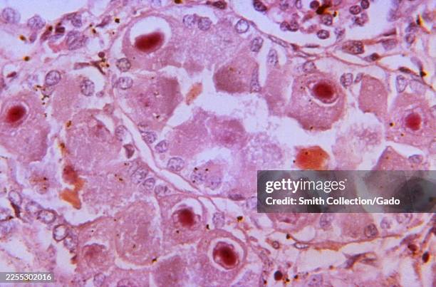 Photomicrograph at 500X shows Lendrum-stained kidney tissue with cytomegalic owl-eye inclusion cells among renal tubules cut in cross section, a...