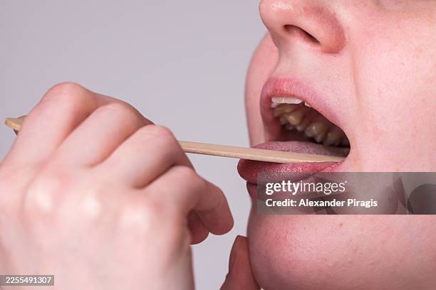 doctor otolaryngologist examines a female patient's oral cavity using a tongue depressor - tongue stock pictures, royalty-free photos & images