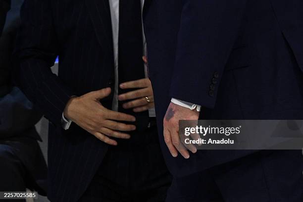 Bruise is seen on the top of the US President Donald Trump's left hand as he attends the signing ceremony of the Peace Charter for Gaza as part of...