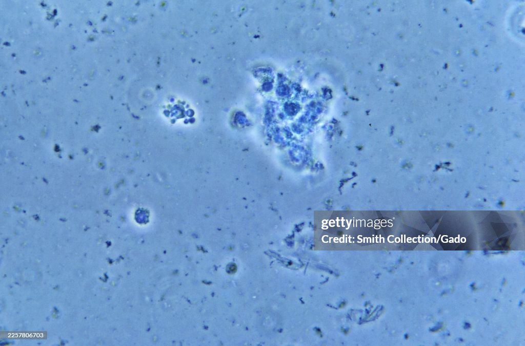 Paracoccidioides Yeast In Sputum