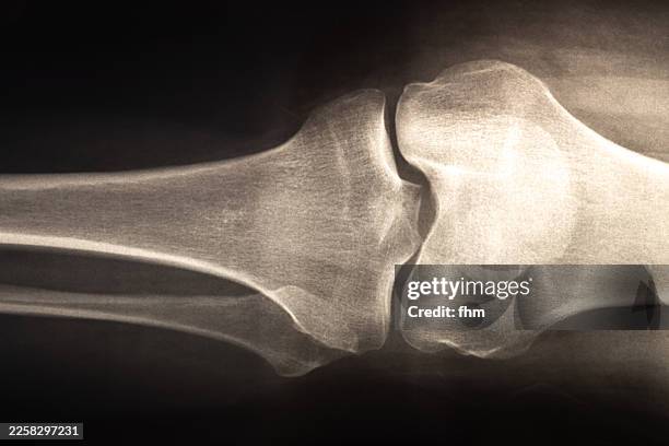 x-ray image of a knee joint with a part of femur and tibia - hueso humano fotografías e imágenes de stock