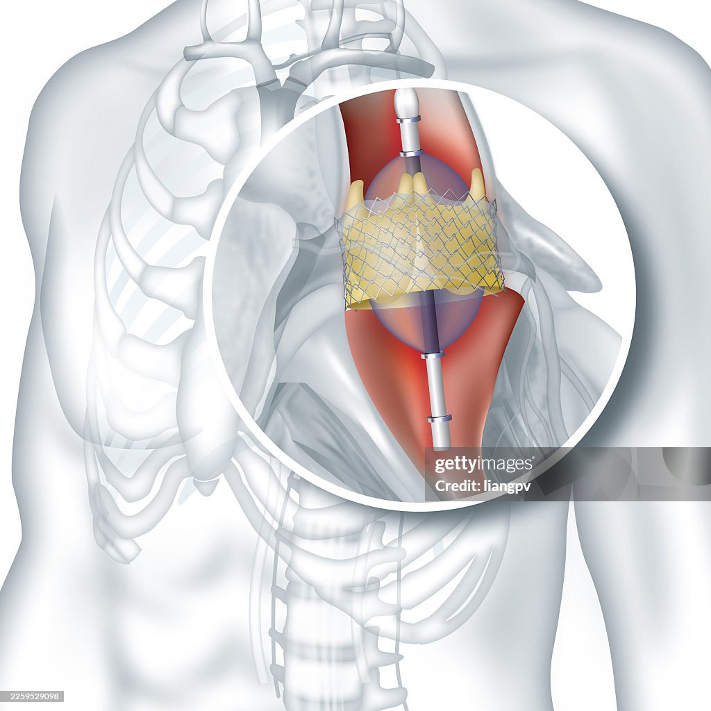 Heart valve replacement