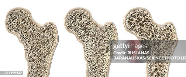 ilustraciones, imágenes clip art, dibujos animados e iconos de stock de healthy and osteoporotic bone structure, illustration - osteoporosis