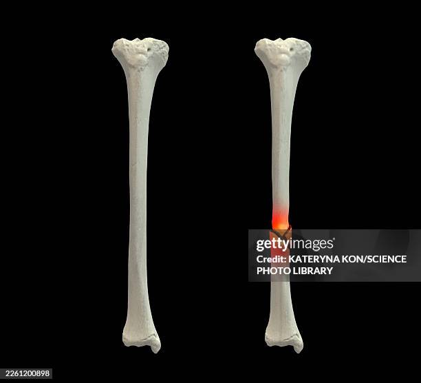 normal tibia bone and tibia shaft fracture, illustration - standardized test stock illustrations
