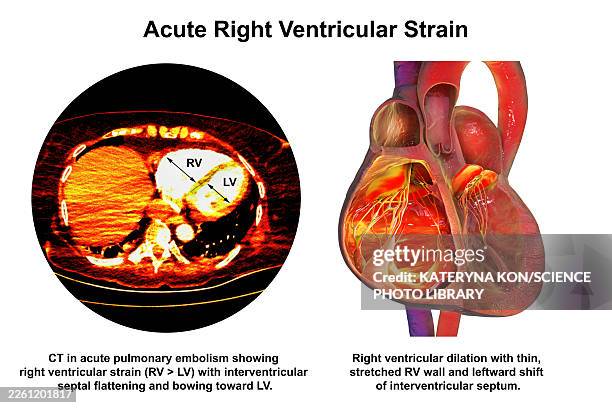 right ventricular dilation, illustration - respiratory failure stock illustrations
