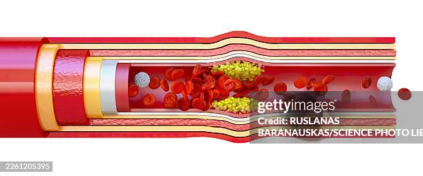 atherosclerosis, illustration - atherosclerosis stock pictures, royalty-free photos & images