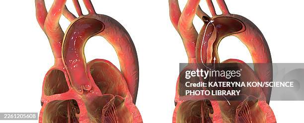 ilustrações de stock, clip art, desenhos animados e ícones de normal aorta and aortic dissection, illustration - aorta