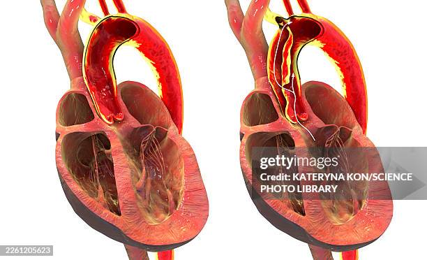 ilustrações de stock, clip art, desenhos animados e ícones de normal aorta and aortic dissection, illustration - aorta