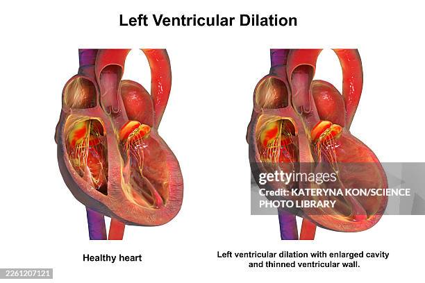 left ventricular dilation, illustration - system failure stock illustrations