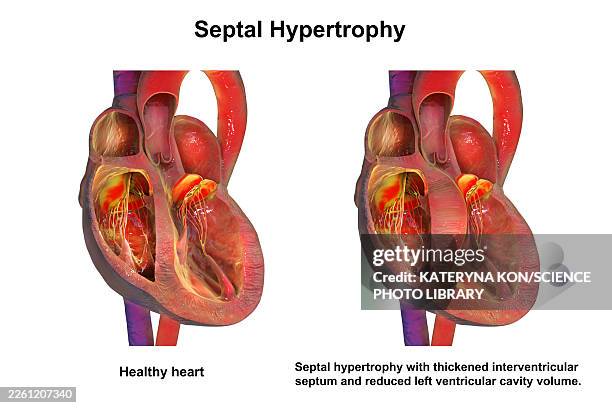 septal hypertrophy, illustration - cardiomyopathy stock illustrations