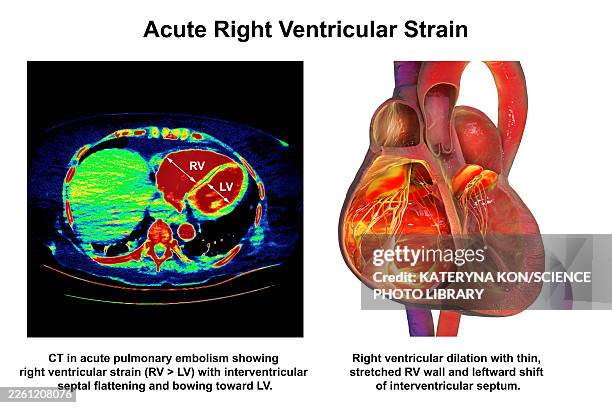 right ventricular dilation, illustration - distorted body stock illustrations