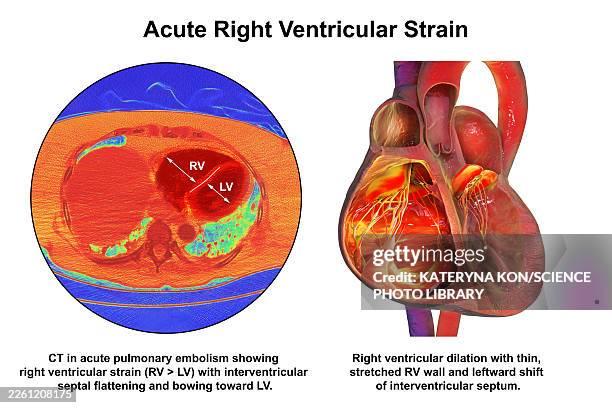 right ventricular dilation, illustration - distorted body stock illustrations