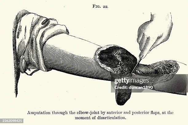 medical history, surgery, amputation through the elbow joint by anterior and posterior flaps, vintage biomedical illustration, 19th century - amputee stock illustrations
