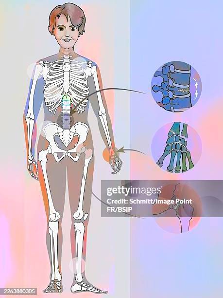 osteoporosis - menopause stock illustrations