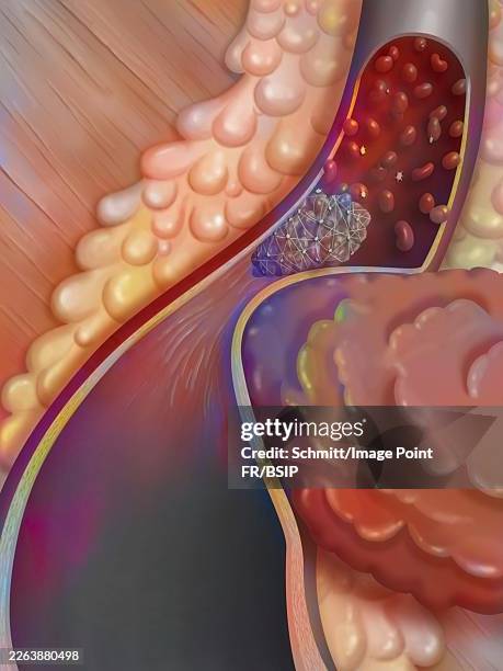 arterial thrombosis - clogged stock illustrations