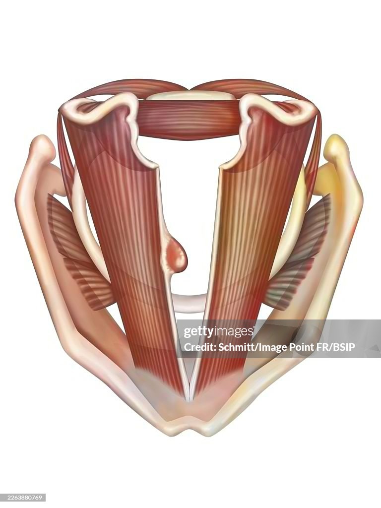 Vocal cord polyp