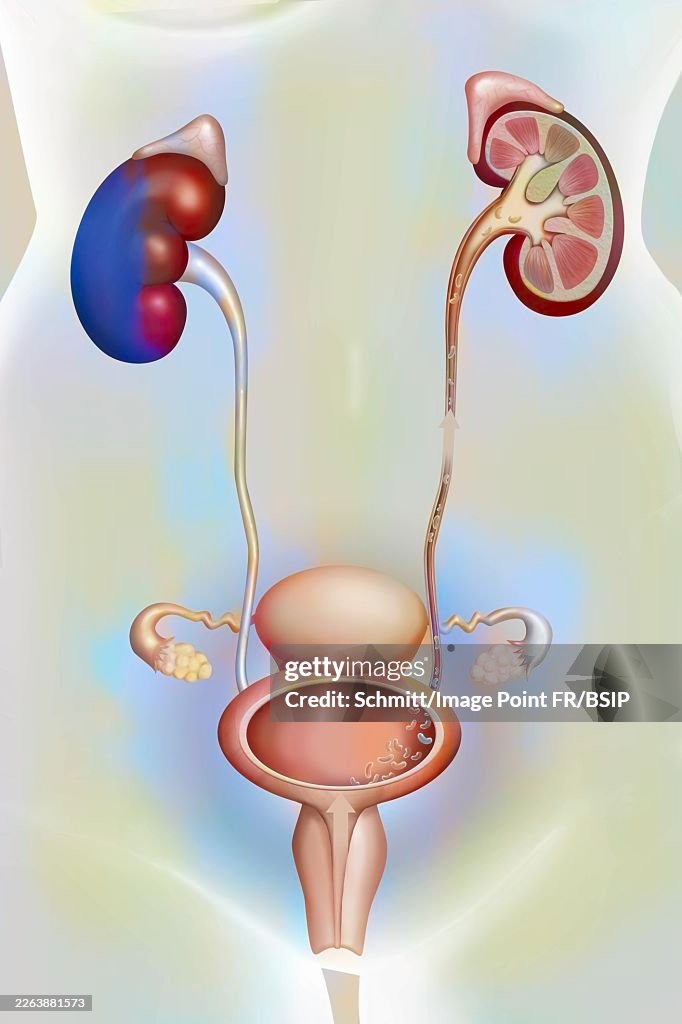Pyelocystitis