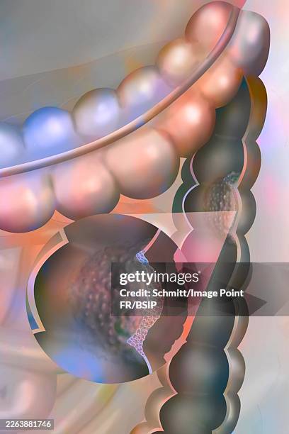 colon cancer - adenocarcinoma stock illustrations