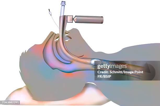 trachea intubation - intubation stock illustrations