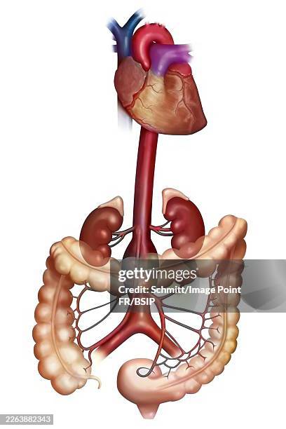 abdominal aortic aneurysm - aortic aneurysm stock illustrations