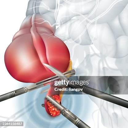 Appendix surgery Appendix surgery
