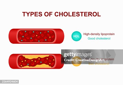 Types Of Cholesterol In Blood Vessel. HDL and LDL Lipoprotein Comparison In Artery Cross Section. Good And Bad Cholesterol Types Of Cholesterol In Blood Vessel. HDL and LDL Lipoprotein Comparison In Artery Cross Section. Good And Bad Cholesterol