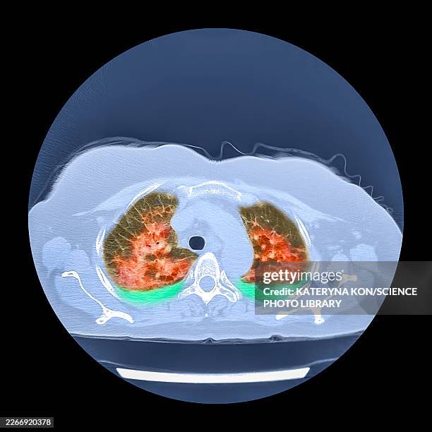 lungs affected by covid-19 pneumonia, ct scan - parenchyma stock pictures, royalty-free photos & images
