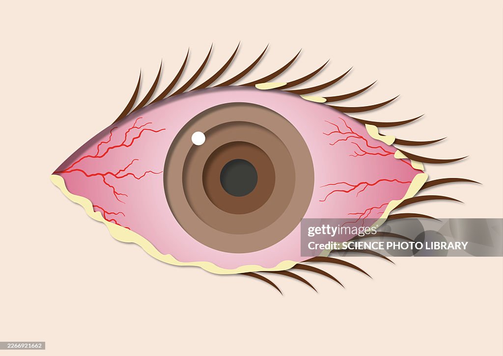 Bacterial conjunctivitis, illustration