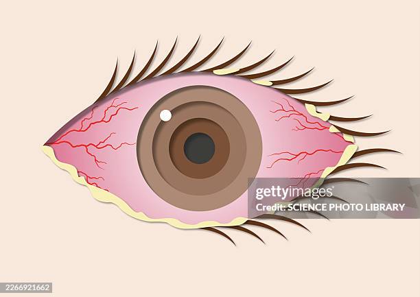 bacterial conjunctivitis, illustration - discharge stock illustrations