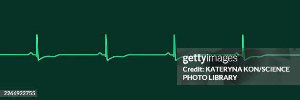right ventricular hypertrophy, illustration - lead testing stock illustrations