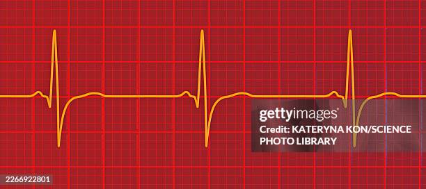 right ventricular hypertrophy, illustration - powerful engine stock illustrations