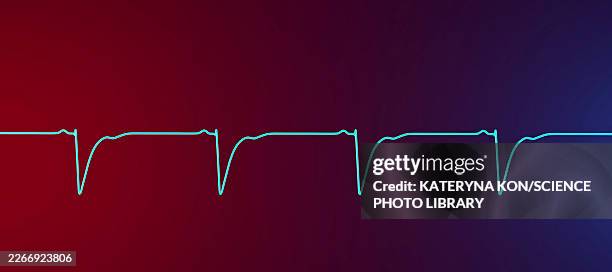 left ventricular hypertrophy, illustration - lead testing stock illustrations