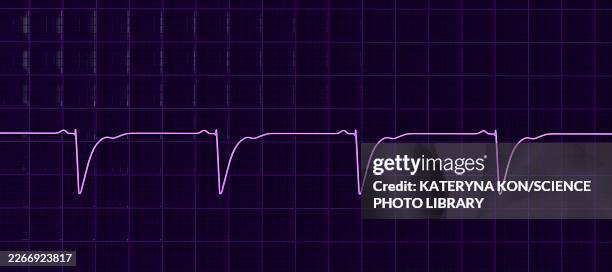 left ventricular hypertrophy, illustration - lead testing stock illustrations