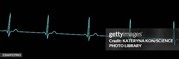 sinus bradycardia, illustration - lead testing stock illustrations