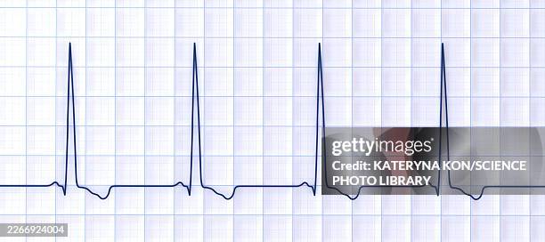 left ventricular hypertrophy, illustration - lead testing stock illustrations