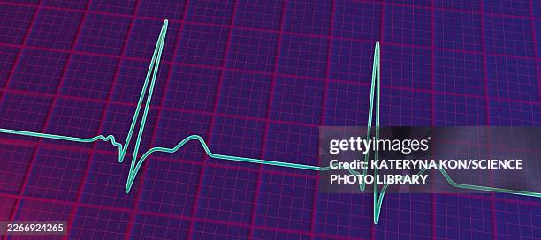 p-mitrale, illustration - hypertrophy stock illustrations