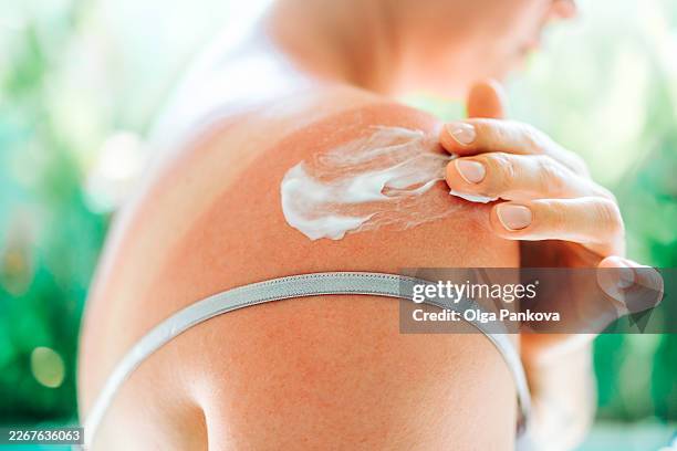 woman applying aftersun cream on sunburned shoulder - sonnenbrand stock-fotos und bilder