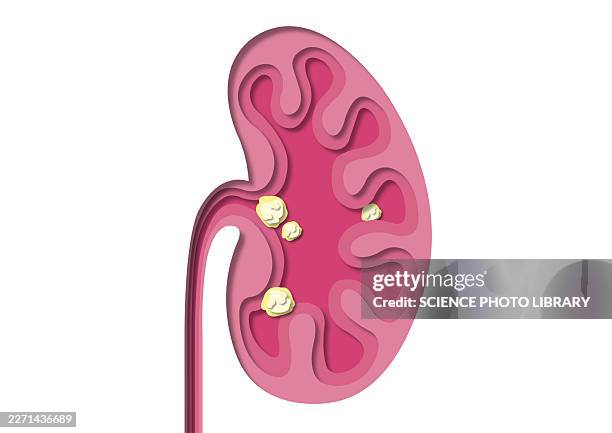 kidney stones, illustration - calculus stock illustrations