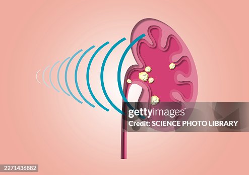 Shockwave therapy for kidney stones, conceptual illustration Shockwave therapy for kidney stones, conceptual illustration