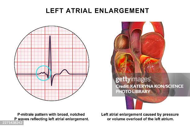 left atrial dilation with p-mitrale, illustration - building atrium stock illustrations