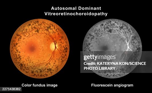 Autosomal dominant vitreoretinochoroidopathy, illustration Autosomal dominant vitreoretinochoroidopathy, illustration