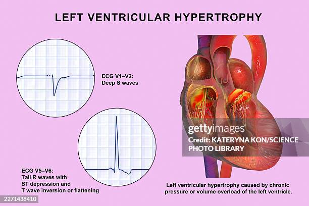 left ventricular hypertrophy, illustration - lead testing stock illustrations