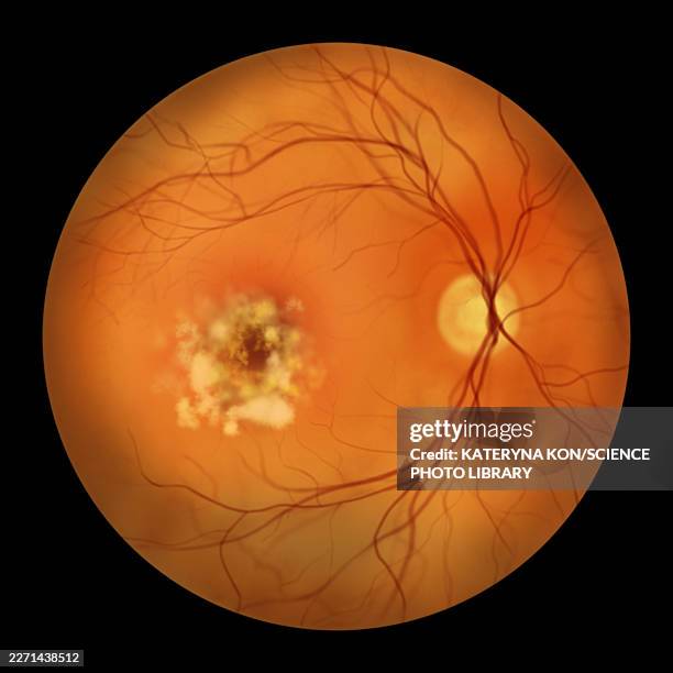 best disease stage 4, illustration - fundus stock illustrations