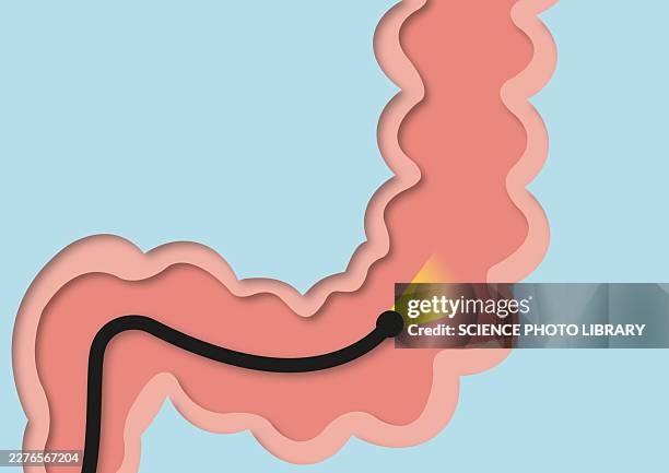 colonoscopy, conceptual illustration - colonoscopy stock illustrations