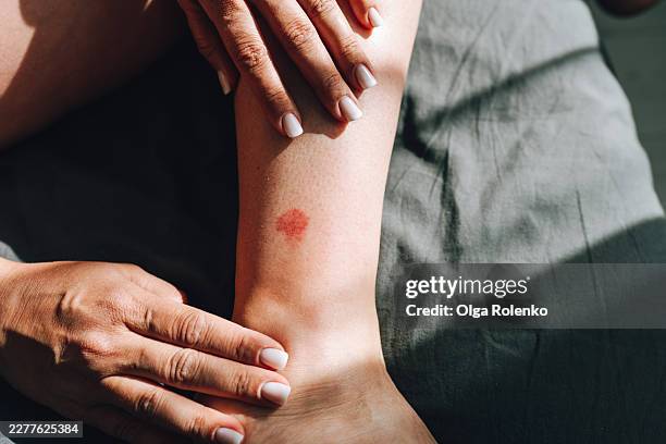 woman touching leg with skin rash and irritation after insect bite - mückenstich stock-fotos und bilder
