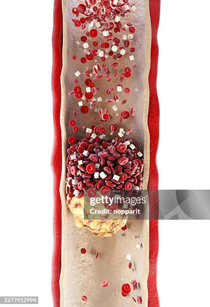 cholesterol plaque in blood vessel - bloodstream stock pictures, royalty-free photos & images