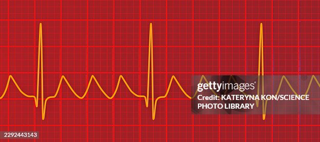 Atrial flutter ECG, illustration Atrial flutter ECG, illustration