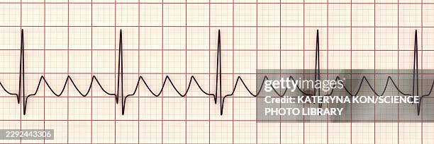 atrial flutter ecg, illustration - base line stock illustrations