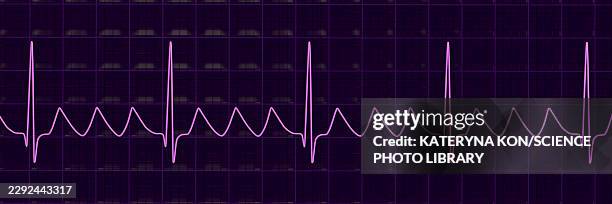 atrial flutter ecg, illustration - base line stock illustrations