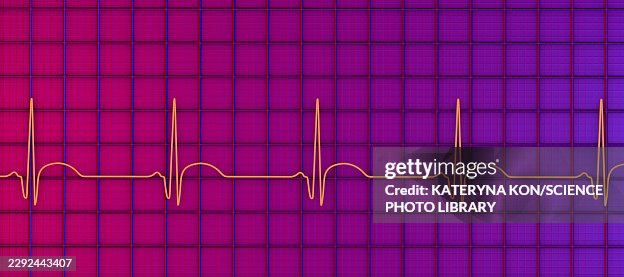 Developing myocardial infarction, illustration Developing myocardial infarction, illustration